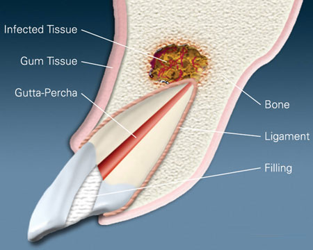 Dental cross-section diagram showing infected tooth tissue, gum tissue, and internal tooth structures including bone and filling.