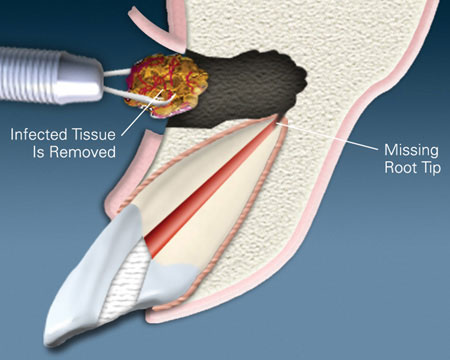 Endodontic procedure illustration showing infected tooth tissue removal and missing root tip during root canal treatment.