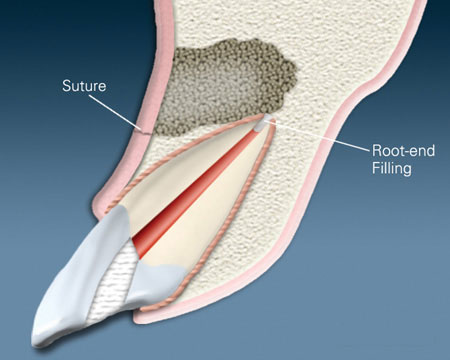 Dental root canal procedure diagram showing tooth cross-section with suture and rock-end filling placement.