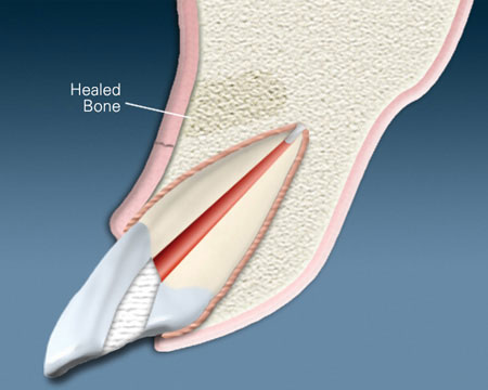 Anatomical cross-section diagram of a tooth showing internal structure and root canal treatment.