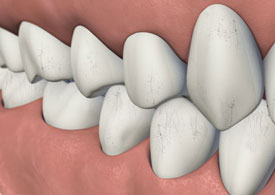 3D dental model showing crowns and tooth restorations on pink gum background.