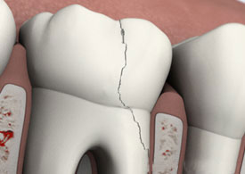 Cracked tooth model displayed with dental instruments on pink surface for endodontic education.