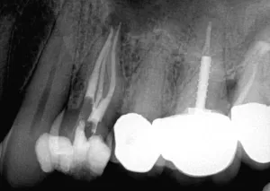 Dental X-ray showing tooth root canal treatment with visible filling material in lower molars.