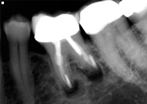 Dental X-ray showing two tooth implants with crowns in upper jaw structure.