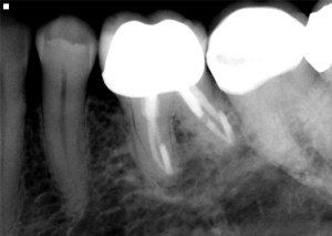 Dental X-ray showing teeth with crowns and endodontic treatment in clinical radiographic view.