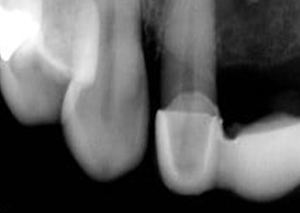 Dental X-ray showing tooth roots and bone structure in black and white radiographic image.