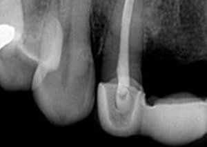 Dental X-ray showing tooth roots and endodontic treatment of posterior teeth
