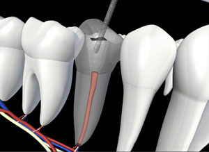 Dental implant diagram showing tooth structure with root canal treatment and surrounding teeth.