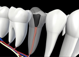 Dental endodontics illustration showing tooth cross-section with root canal treatment procedure visualization.