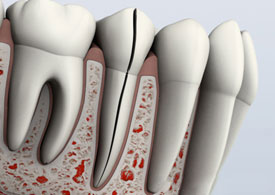 Five dental endodontic instruments with red measurement markings arranged in a row against white background.