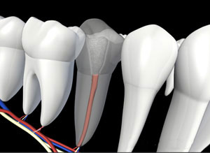 3D dental illustration showing tooth cross-section with root canal anatomy and treatment visualization.