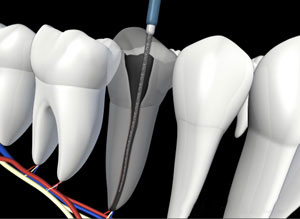 Dental endodontic procedure illustration showing root canal treatment with instruments and tooth cross-section.