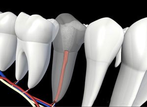 Dental implant diagram showing tooth cross-section with root canal and surrounding teeth illustration.
