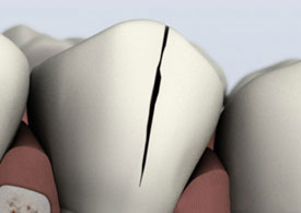 Dental model showing tooth with vertical access line for endodontic root canal treatment procedure.