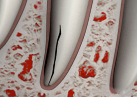 Dental file instruments with red debris particles on white textured surface, endodontic tools closeup.