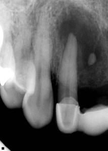 surgical treatment of large periapical cyst with one year healing before