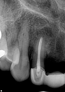 surgical treatment of large periapical cyst with one year healing after